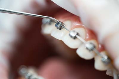 A Step By Step Process Of How Braces Work