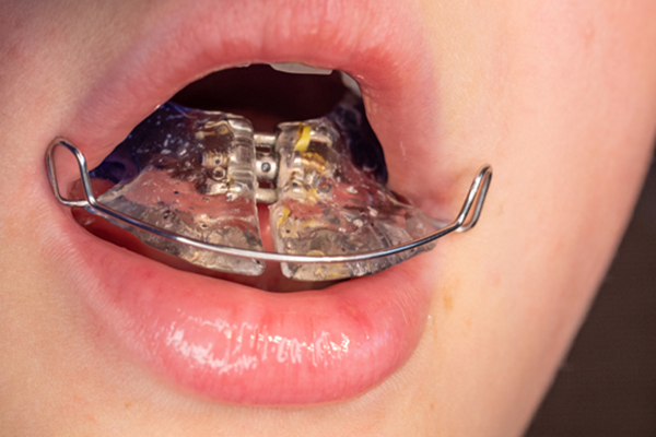 When And Why Expanders Are Recommended By Orthodontists